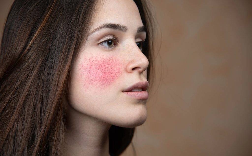 skin-irritation-Rosacea-eczema